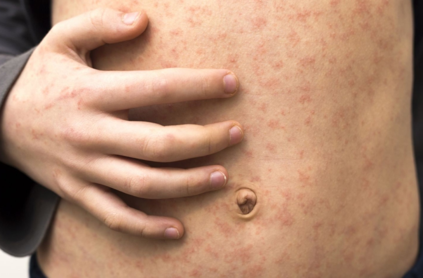  CDC warns progress against measles threatened amid COVID-19 pandemic – Fox News