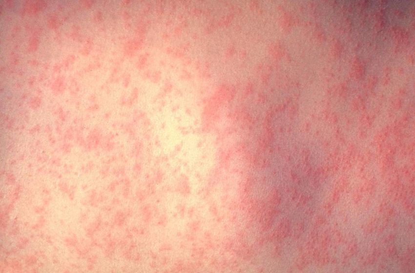  Doctors warn of highly-contagious virus that could become a global threat to children – WSB Atlanta