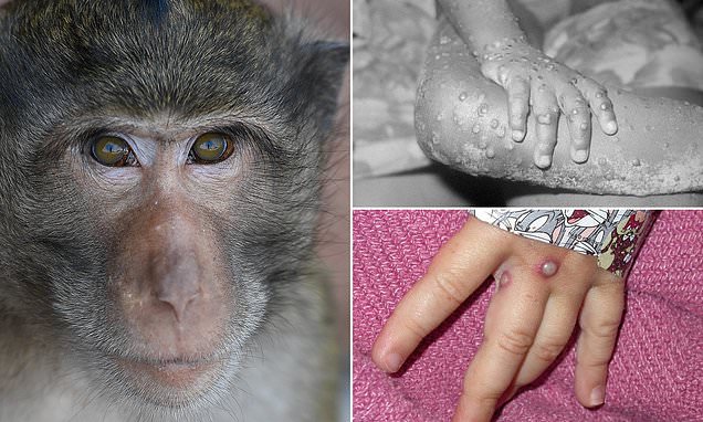  US is hit by MONKEYPOX: Maryland patient tests positive for the rare virus after a trip to Nigeria – Daily Mail