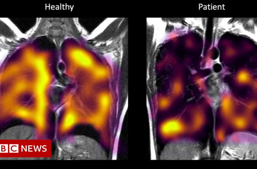  Long Covid: Hidden lung damage spotted on scans – BBC News