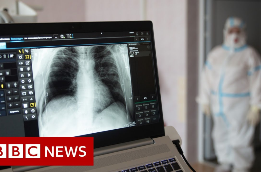  Some long Covid patients may have hidden damage to their lungs – BBC News – BBC News